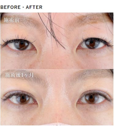 TCB東京中央美容外科の二重整形の症例