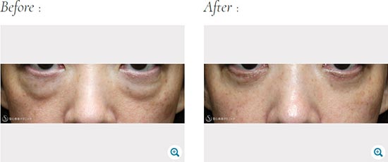 聖心美容クリニックの下眼瞼切開術/下眼瞼除皺術/ハムラ法の症例