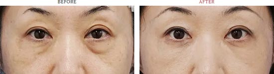 もとび美容外科クリニックの目の下脂肪注入（コンデンス法）の症例