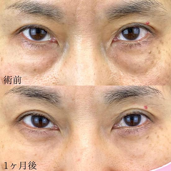 TCB東京中央美容外科のクマ取り･たるみ取り治療の症例