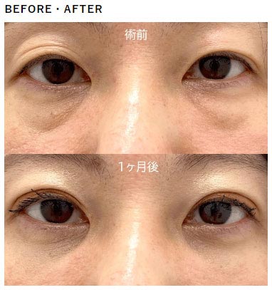 TCB東京中央美容外科の切らない目の下のクマ取り・目の下のたるみ取り、二重整形埋没法の症例