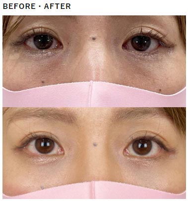TCB東京中央美容外科の切らない目の下のクマ取り・目の下のたるみ取りの症例