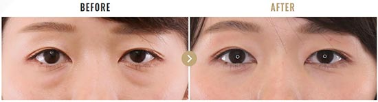 TAクリニックの下眼瞼脱脂術の症例