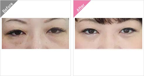 渋谷美容外科クリニックの下眼瞼脱脂の症例