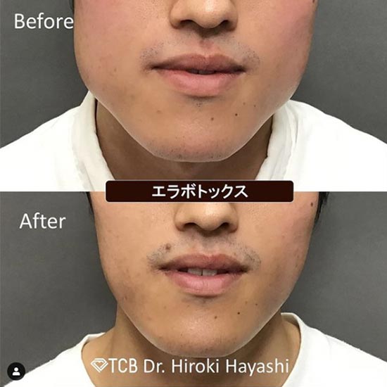 TCB東京中央美容外科のエラボトックスの症例