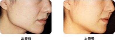 シロノクリニックの小顔効果・注入治療の症例