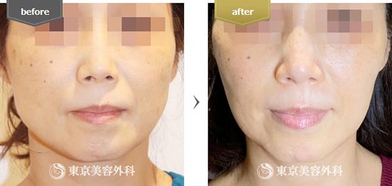 東京美容外科のエラボトックス注射の症例
