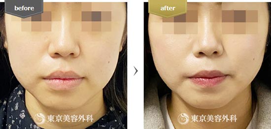 東京美容外科のエラボトックス（コアトックス）の症例
