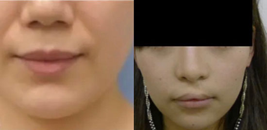左がアラガン社製、右が韓国製ボツリヌストキシンのアフター写真