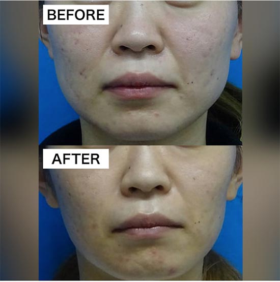 TCB東京中央美容外科のエラボトックスの小顔注射の症例
