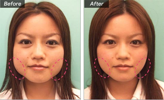 城本クリニックのエラボトックス治療による小顔矯正の症例
