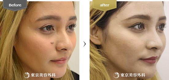 東京美容外科のほくろ除去（切開）の症例
