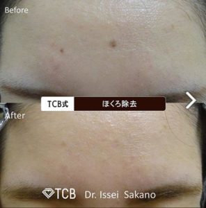 TCB東京中央美容外科のレーザー治療の症例