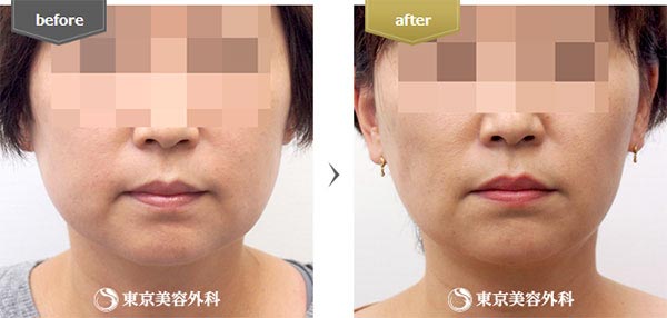 東京美容外科の脂肪吸引（ホホ・フェイスライン・アゴ）の症例