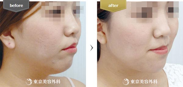 東京美容外科の脂肪吸引（フェイスライン）の症例