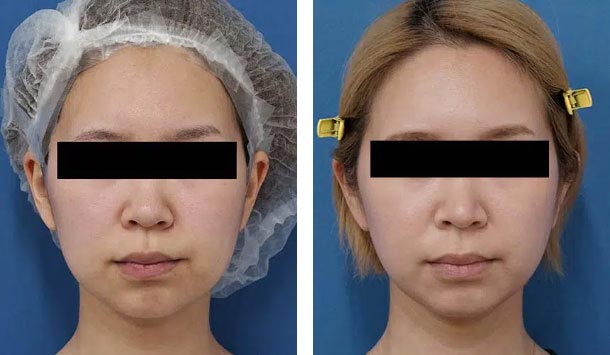 もとび美容外科クリニックの小顔脂肪吸引（ホホ・アゴ下）の症例
