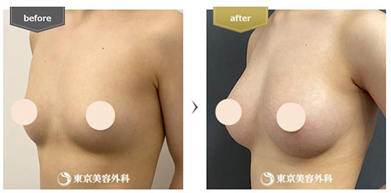 東京美容外科の豊胸手術の症例