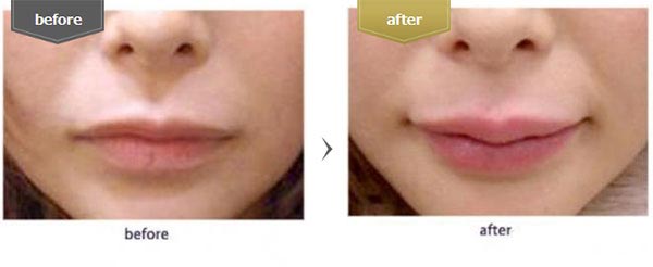 東京美容外科の口：ヒアルロン酸注入の症例