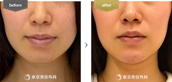 東京美容外科の顎ヒアルロン酸の症例