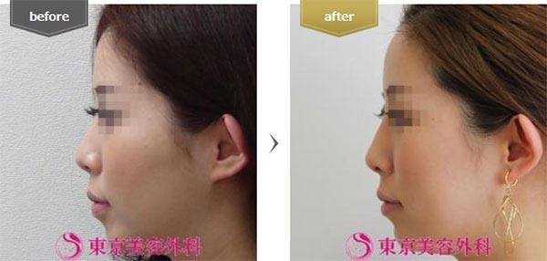 東京美容外科の鼻ヒアルロン酸の症例
