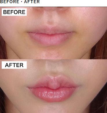 TCB東京中央美容外科の唇のヒアルロン酸注射の症例