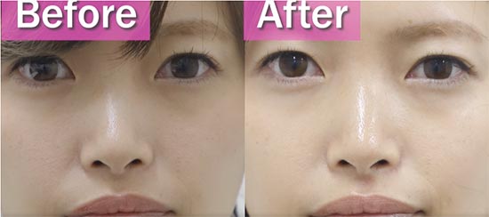 TCB東京中央美容外科のフラクショナルレーザーの症例