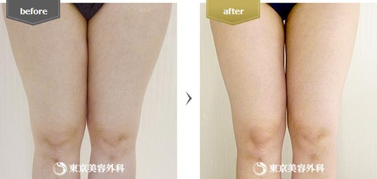 東京美容外科の脂肪吸引（大腿部）の症例