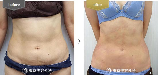 東京美容外科の脂肪吸引（上下腹部）の症例