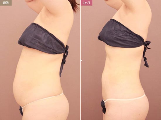 モッズクリニックのベイザー脂肪吸引（腹部全体＋胸下＋腰）の症例
