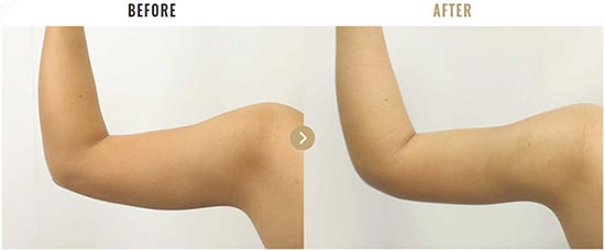 TAクリニックの二の腕の脂肪吸引の症例
