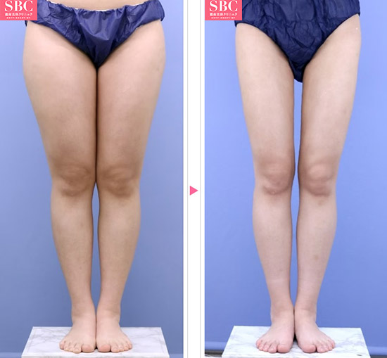 脂肪吸引（下半身）の施術前と施術6ヶ月後の症例写真