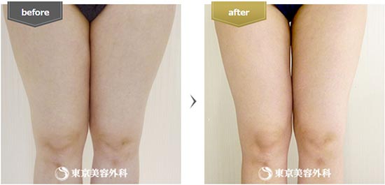 東京美容外科の脂肪吸引 大腿部 内側の症例