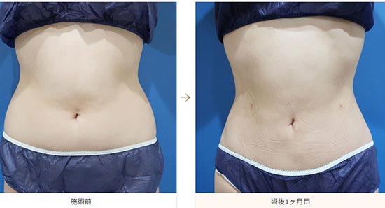 水の森美容クリニックの脂肪吸引（上下腹部・ウエスト・腰）の症例