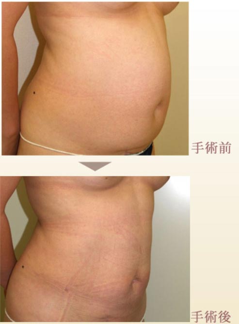 タウン形成外科クリニックの腹部の脂肪吸引の症例