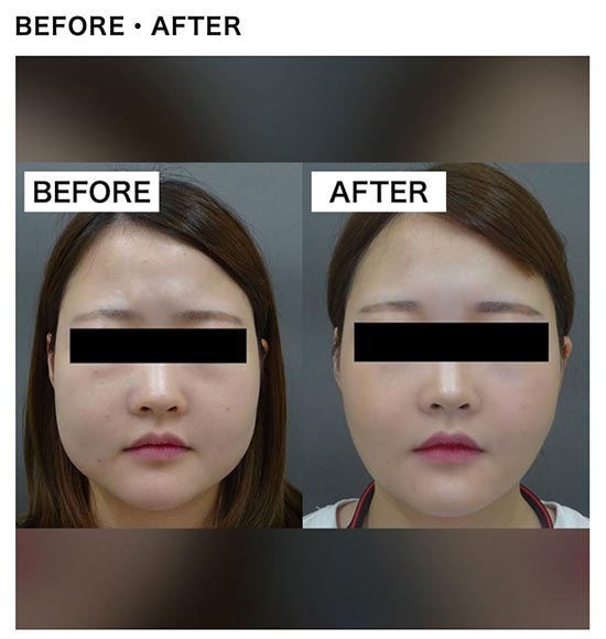 TCB東京中央美容外科の顔（頬・頬骨上・顎下）の脂肪吸引の症例