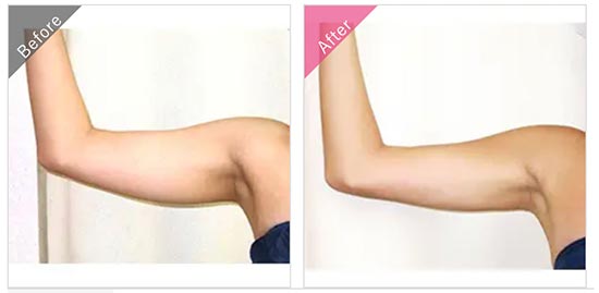 渋谷美容外科クリニックの二の腕　脂肪吸引（ボディジェット）の症例