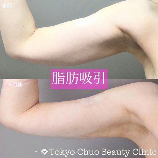 TCB東京中央美容外科の脂肪吸引（二の腕・肩）の症例