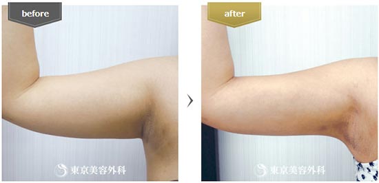 東京美容外科の脂肪吸引（二の腕全周）の症例