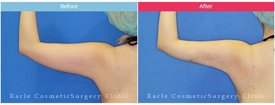 新宿ラクル美容外科クリニックの脂肪吸引（二の腕・背中上部）の症例