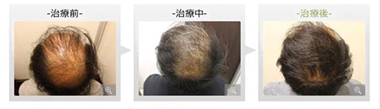 銀座総合美容クリニックの内服薬療法+ノーニードル育毛メソセラピーの症例