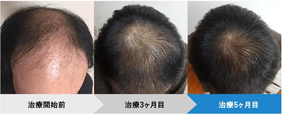 AGAヘアクリニックの頭頂部の薄毛治療の症例