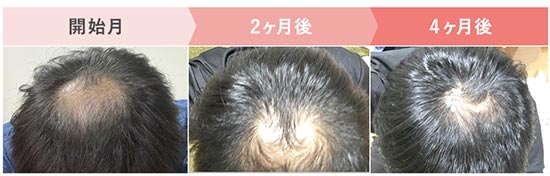 クリニックフォアの発毛ライトプラン（フィナステリド、ミノキシジル内服）4ヶ月、スカルプケアサプリ1ヶ月の症例