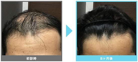 AGAメディカルケアクリニックのオリジナル発毛治療+メディカルケア発毛メソセラピーの症例