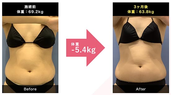 湘南美容クリニックのリベルサスで3カ月で-5.4kgの減量成功した症例写真の症例