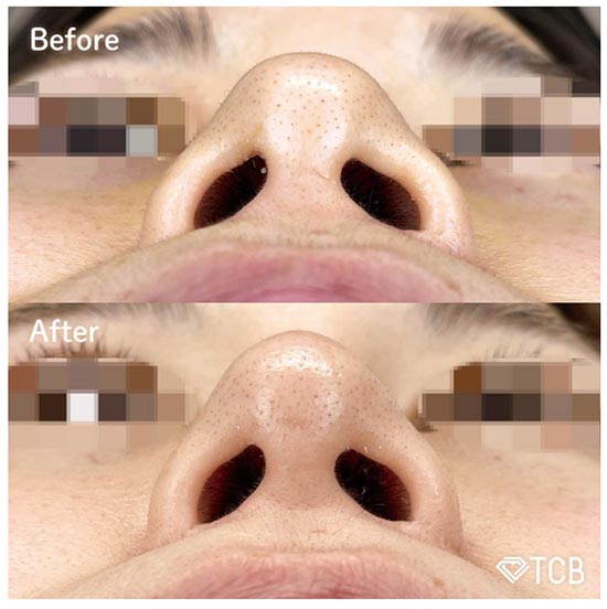 TCB東京中央美容外科の鼻尖形成完全閉鎖法（切らない鼻尖形成）の症例