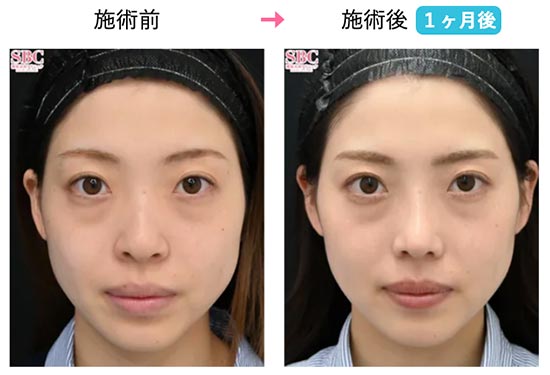 湘南美容クリニックのSBCプレミアムソフトプロテーゼ、鼻尖形成術3D法、小鼻縮小（フラップ）の症例