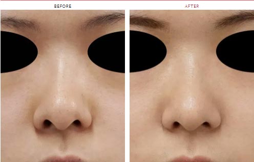 もとび美容外科クリニックの鼻尖縮小（団子鼻の整形）の症例