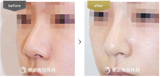 東京美容外科の鼻尖形成（切開法+軟骨移植）、隆鼻術（オーダーメードプロテーゼ）の症例