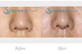 聖心美容クリニックの鼻尖縮小+鼻尖形成（耳介軟骨移植）+鼻柱下降（耳介軟骨移植）の症例