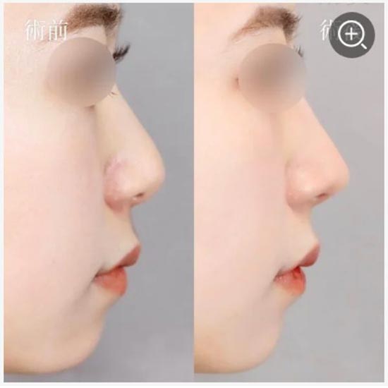 TCB東京中央美容外科の鼻尖形成の症例